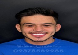 کامپوزیت لمینت عصب کشی کرج در دندانپزشکی ماهانا