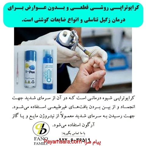 کرایوتراپی زگیل تناسلی یک روش قطعی و بدون عوارض